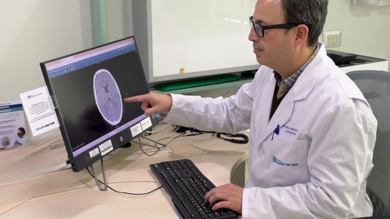 Día Mundial del Cerebro: Hasta el 90% de algunos ACV podrían prevenirse